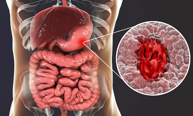 Peptic Ulcer Symptoms – Stomach Pain Patterns To Track