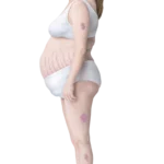 Cushing's Syndrome Symptoms: Weight Gain, Moon Face, and Skin Changes