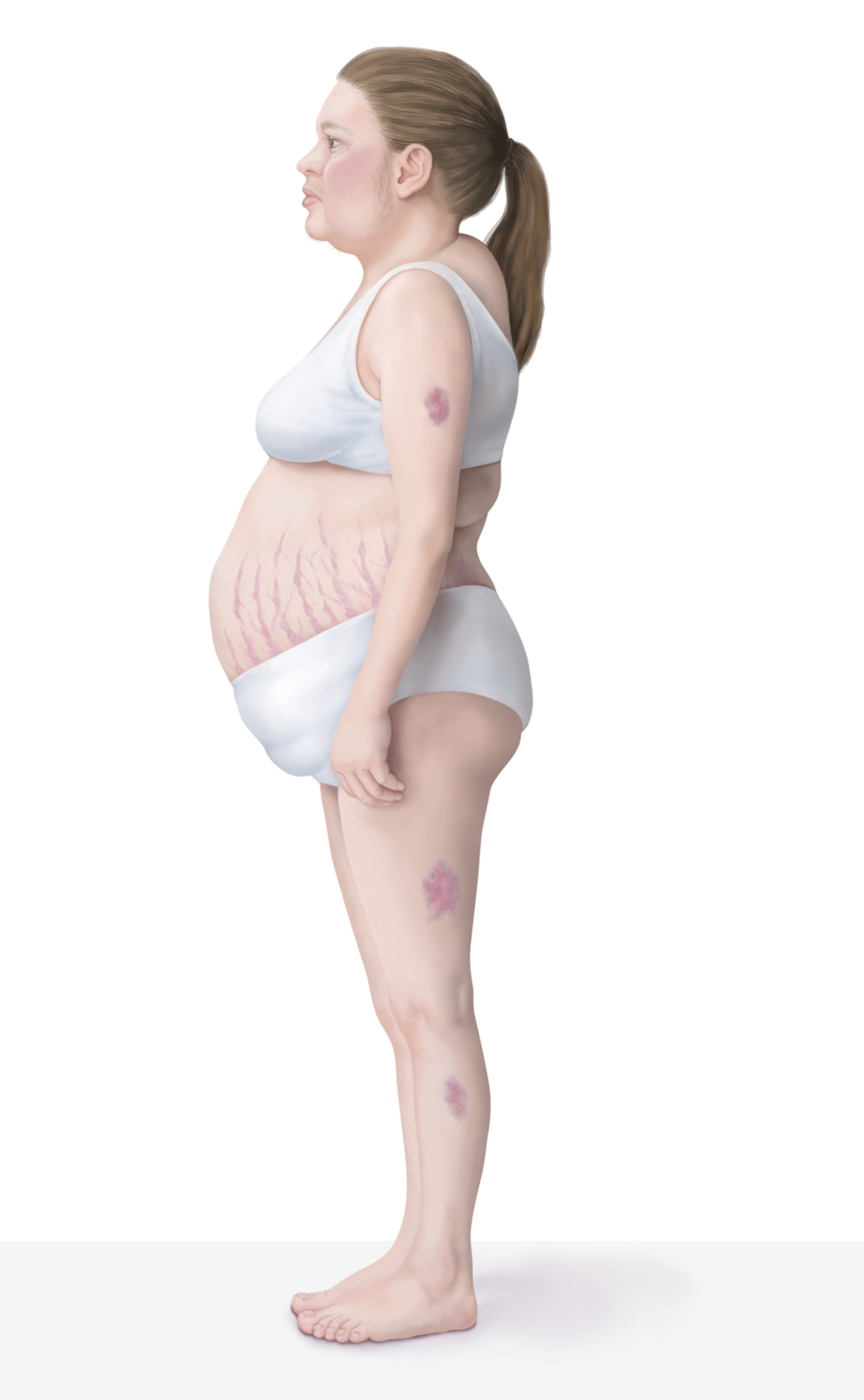 Cushing's Syndrome Symptoms: Weight Gain, Moon Face, and Skin Changes