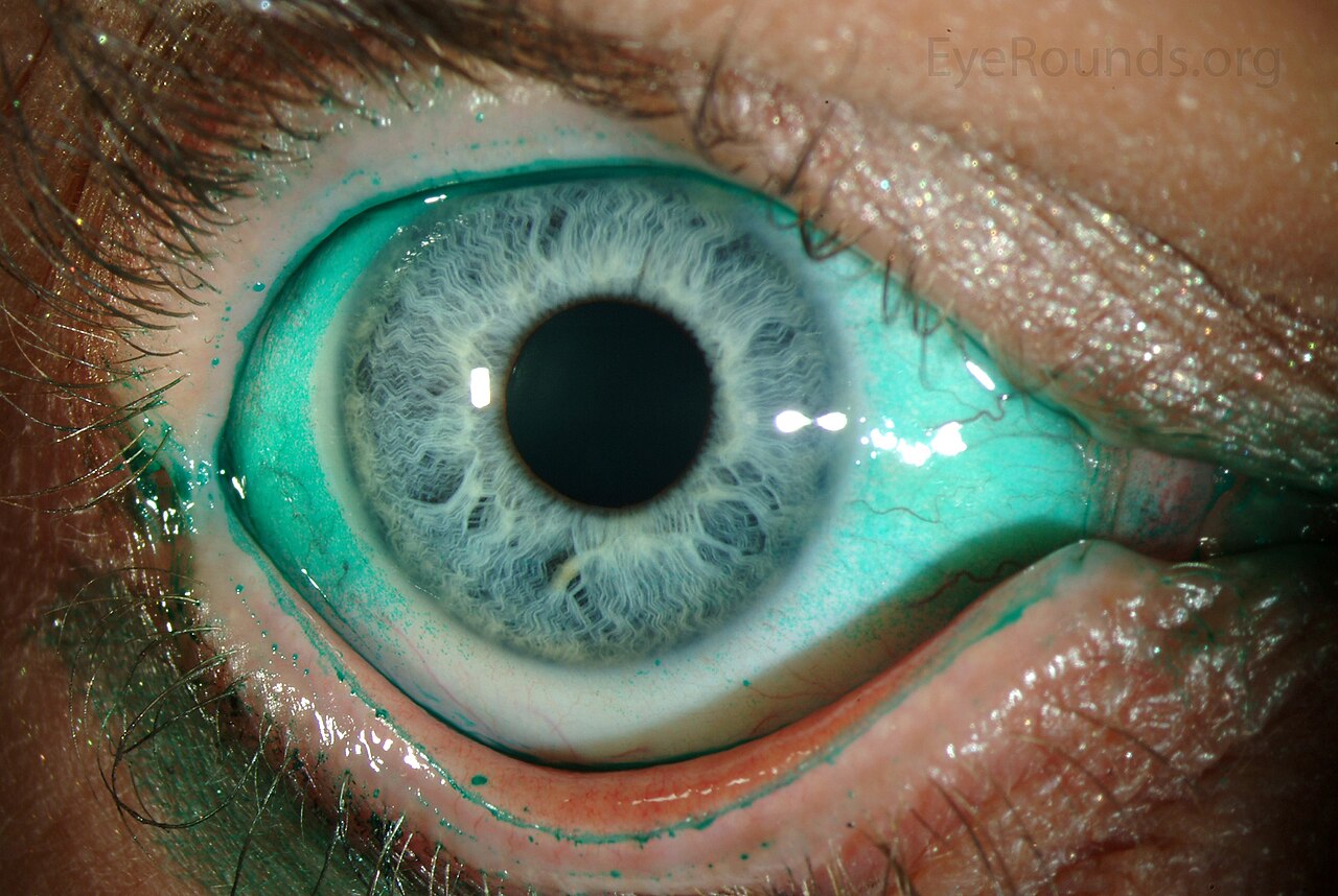 Dry Eye Syndrome Symptoms: Burning, Gritty Eyes Explained Clearly