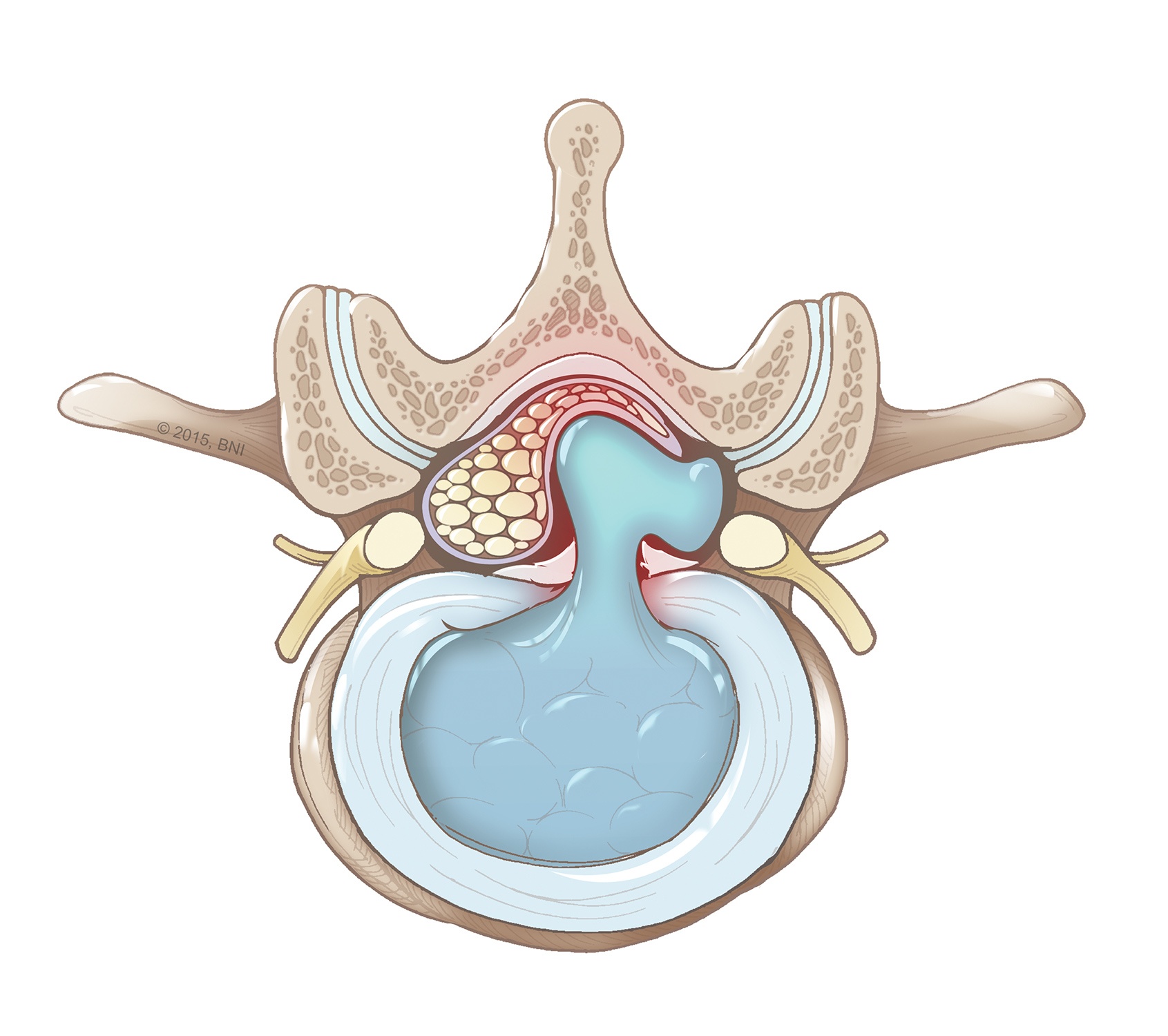 Herniated Disc Symptoms: Nerve Pain and Numbness Explained
