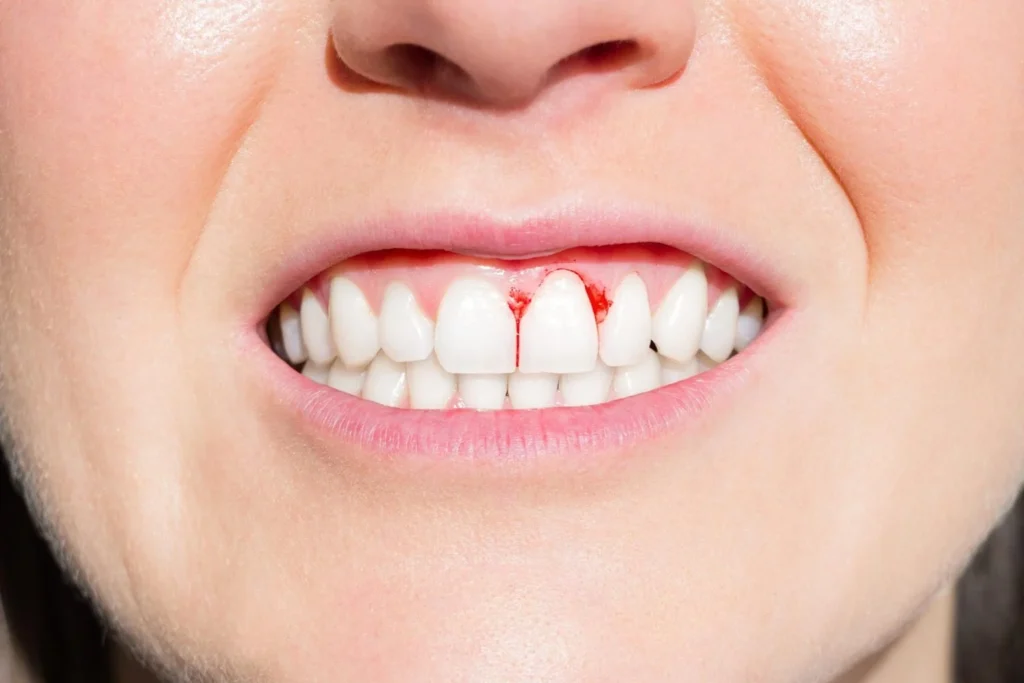 Scurvy Symptoms: Bleeding Gums and Other Vitamin C Warning Signs