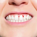 Scurvy Symptoms: Bleeding Gums and Other Vitamin C Warning Signs
