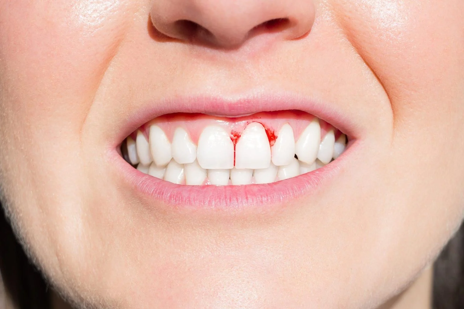Scurvy Symptoms: Bleeding Gums and Other Vitamin C Warning Signs