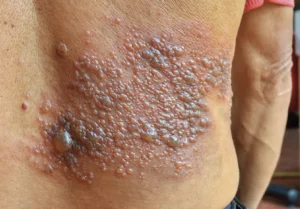 Shingles Symptoms: Painful Rash, Tingling, and Nerve Burning