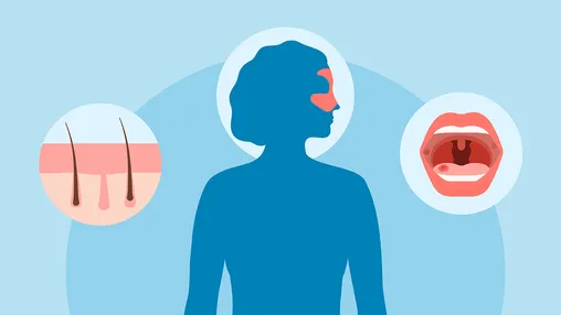 Lupus Symptoms – Butterfly Rash And Hidden Signs
