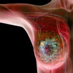 Breast Cancer Symptoms – Lumps And Changes To Check