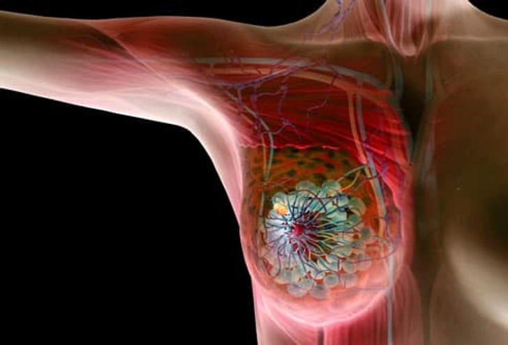 Breast Cancer Symptoms – Lumps And Changes To Check