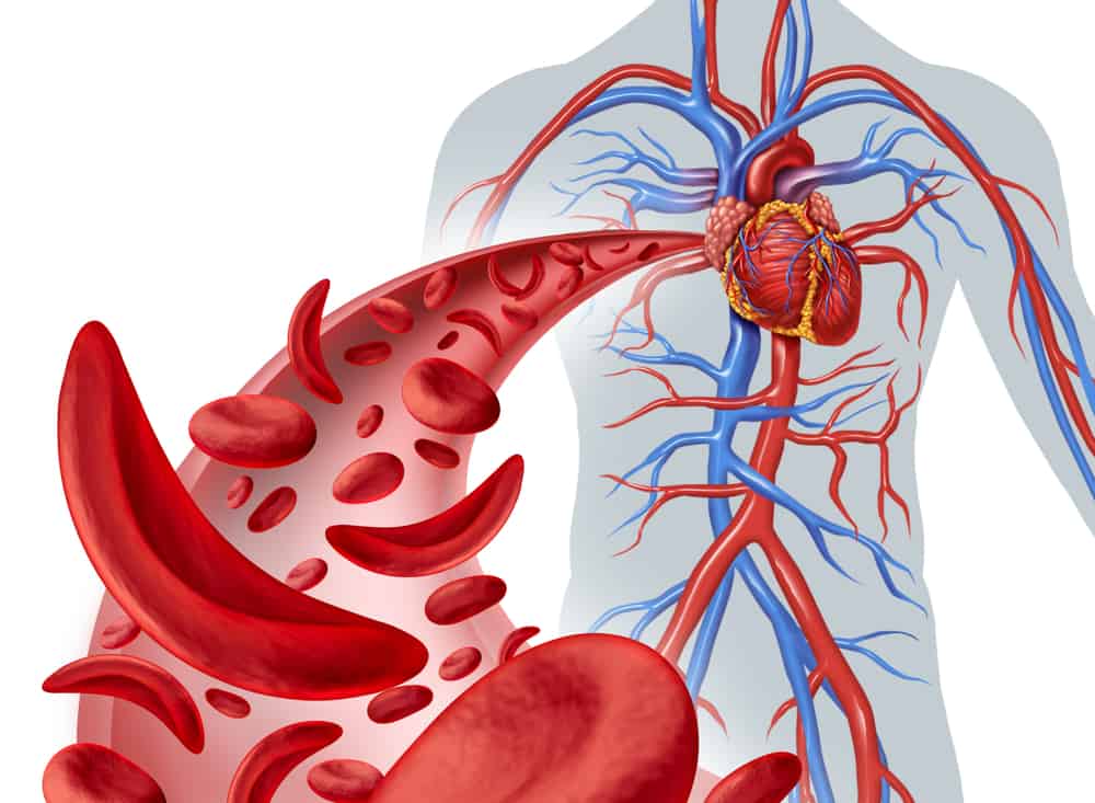 Sickle Cell Anemia Symptoms – Painful Crisis Episodes Explained Simply